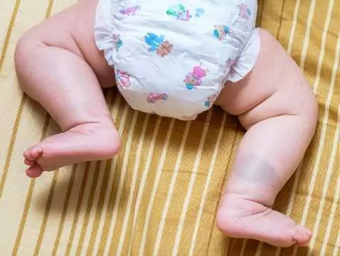 Nappy dermatitis - how to deal with this bothersome ailment?