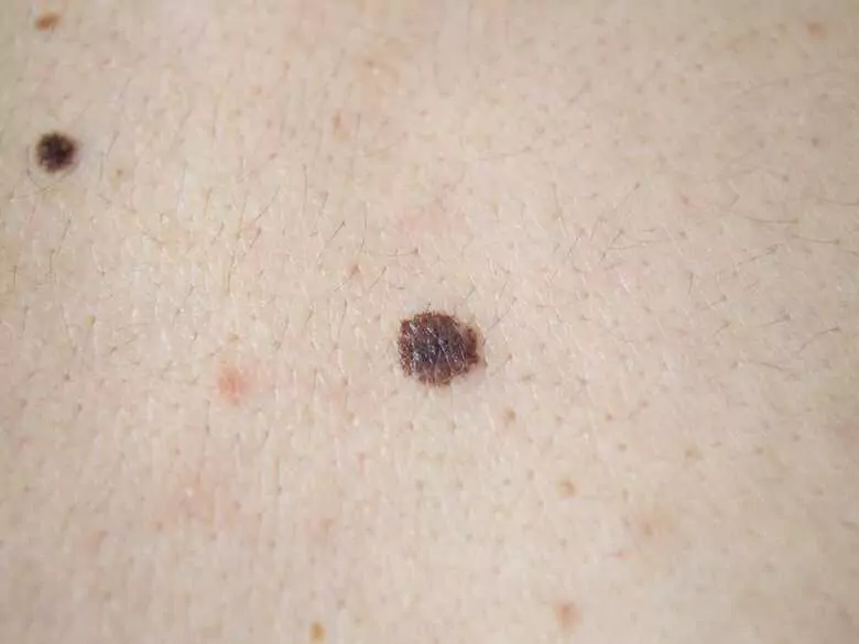 Disturbing moles - what should make you alert?