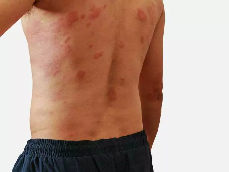 Allergic versus irritant contact eczema: how do they differ?