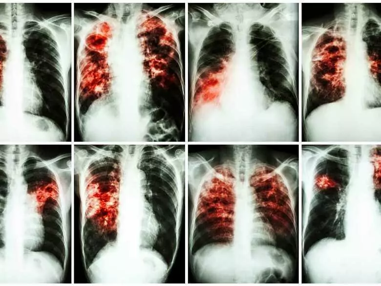 Czech scientists have invented a new drug against tuberculosis