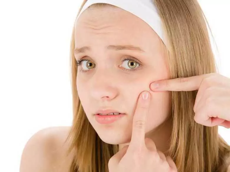 Pathogenesis and treatment of acne vulgaris