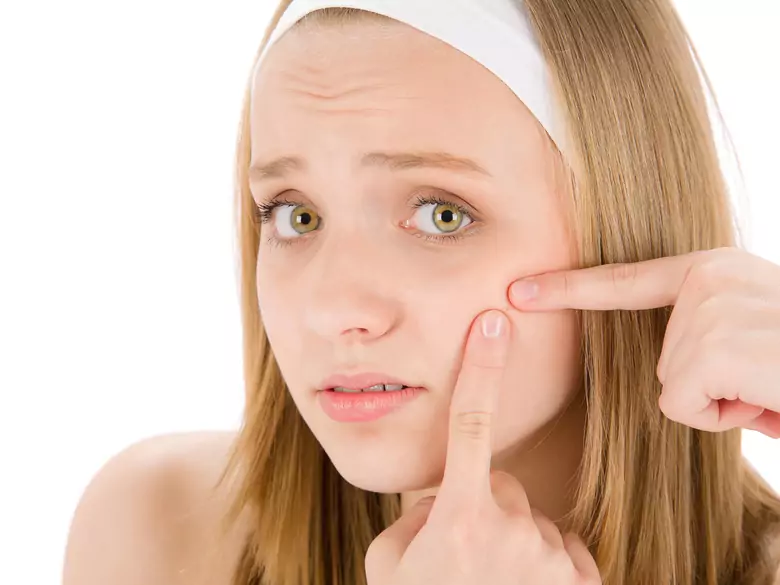 Pathogenesis and treatment of acne vulgaris