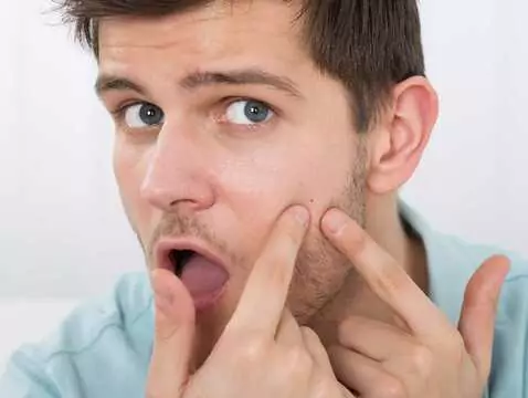 Acne in adults: why are more and more 30-year-olds struggling with skin lesions?
