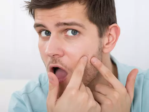 Acne in adults: why are more and more 30-year-olds struggling with skin lesions?
