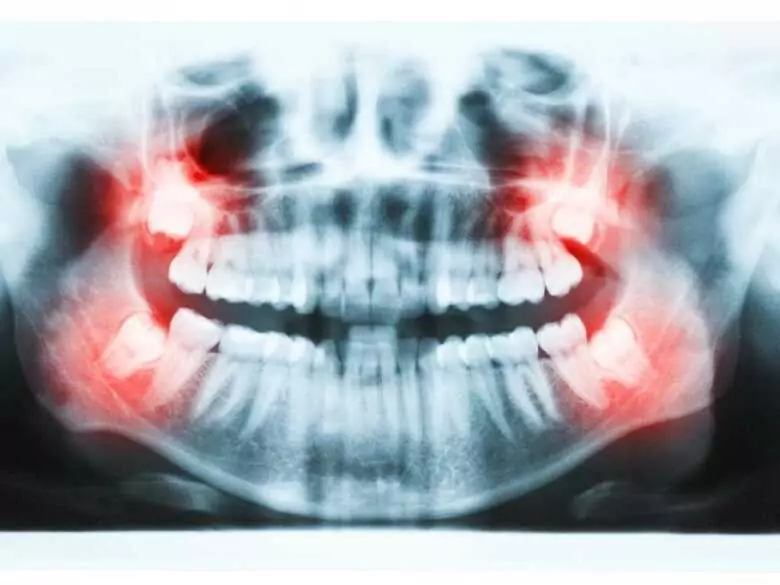 Emerging wisdom teeth - how to relieve pain?