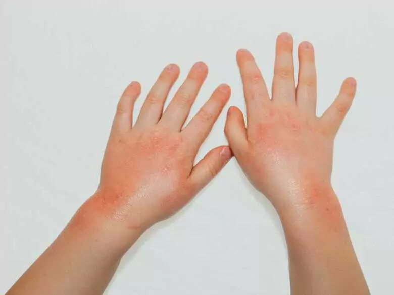 Are there home remedies for urticaria?