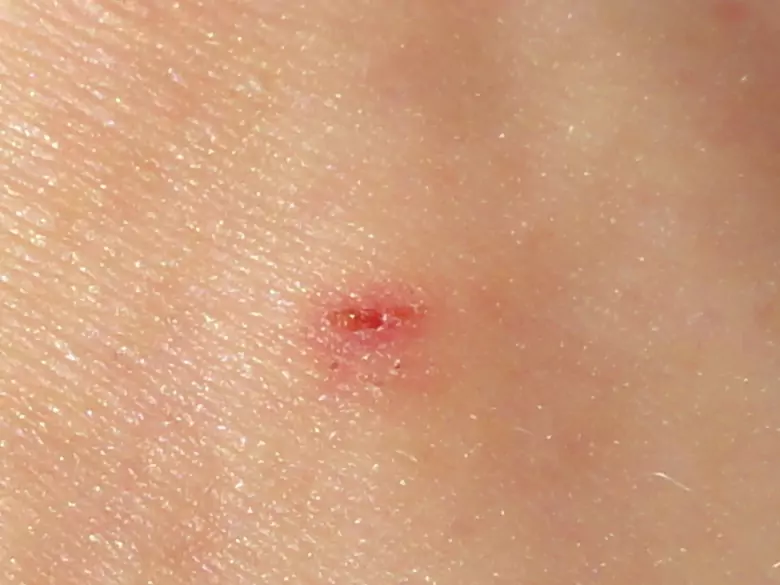 Regular nevus checks can save lives