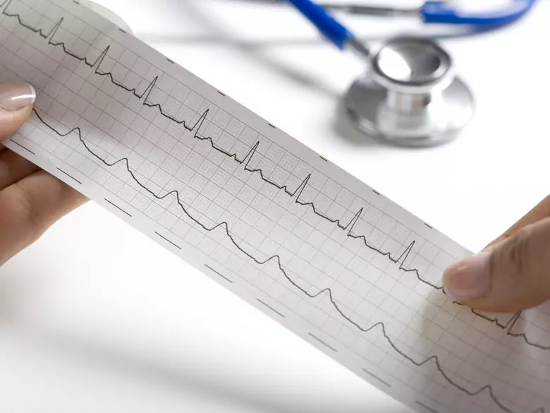 Cardiomyopathies - classification and treatment