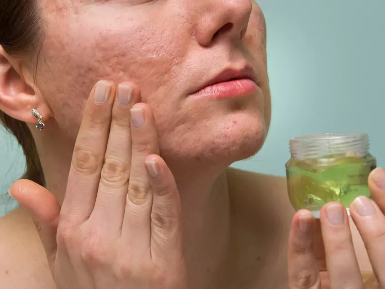 Ways to remove scars