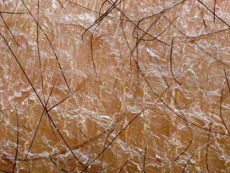 How to deal with seborrhoea problems?