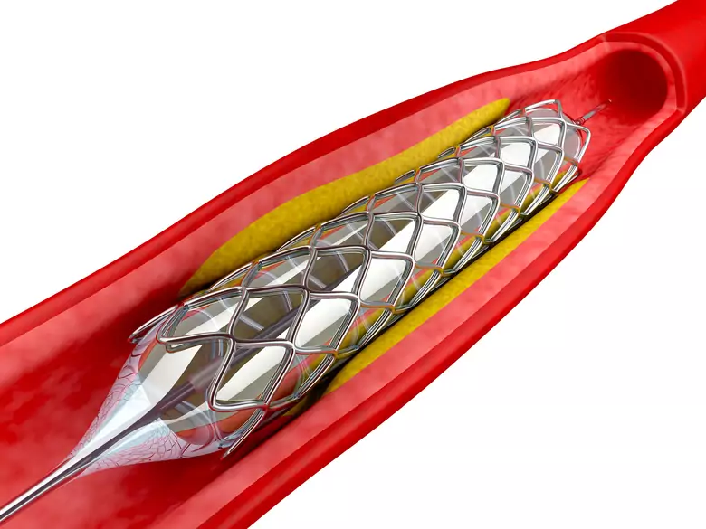 Aortic aneurysm - causes, symptoms, diagnosis, treatment
