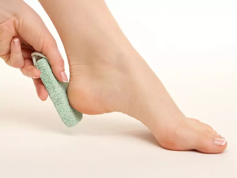Cracked heels - a painful problem