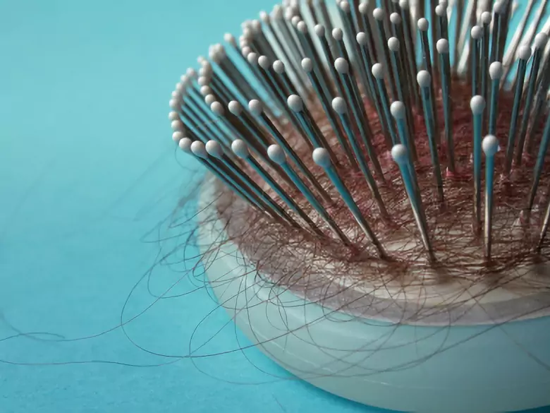 Hair loss - causes, symptoms, diagnosis, treatment