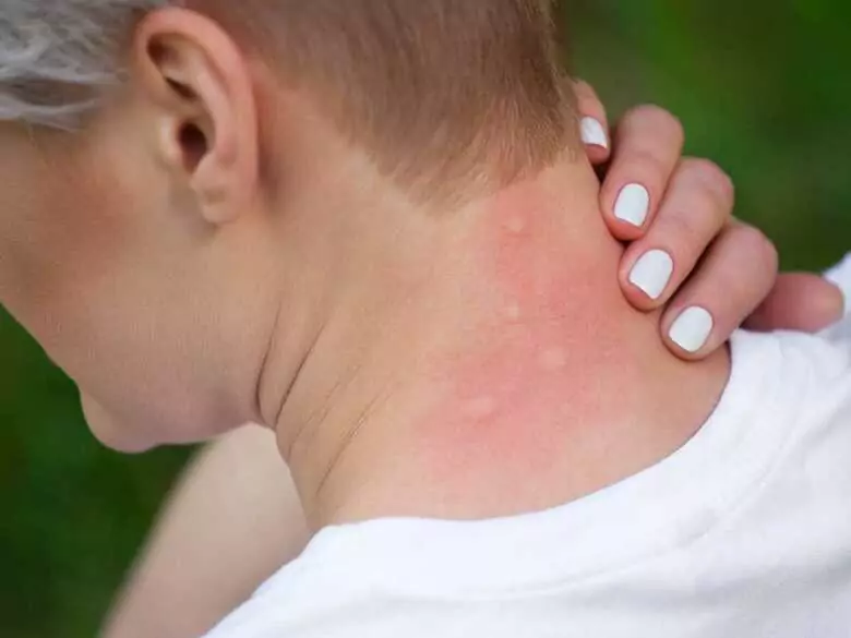 Treatment of seborrhoeic dermatitis - new insights