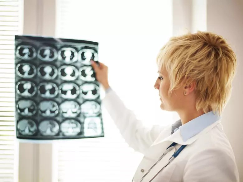 Use of lithium in the treatment of cognitive impairment after radiotherapy