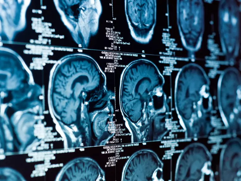Multiple sclerosis - diagnosis