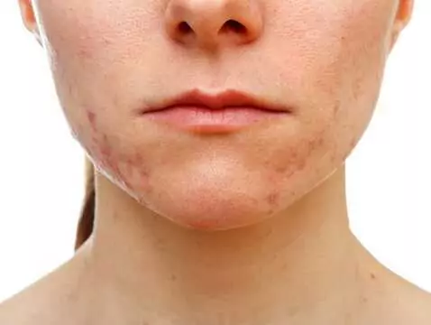 Shaping of hair follicles may be a cause of acne formation