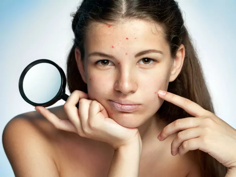 Acne rosacea - causes, symptoms, diagnosis, treatment