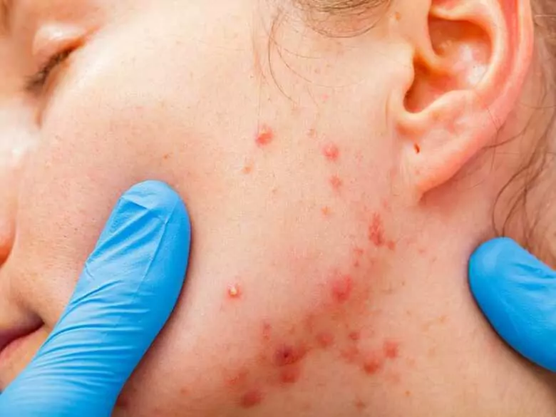 Antibiotics in the treatment of acne - when are they used?