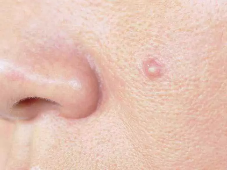 Atypical forms of rosacea