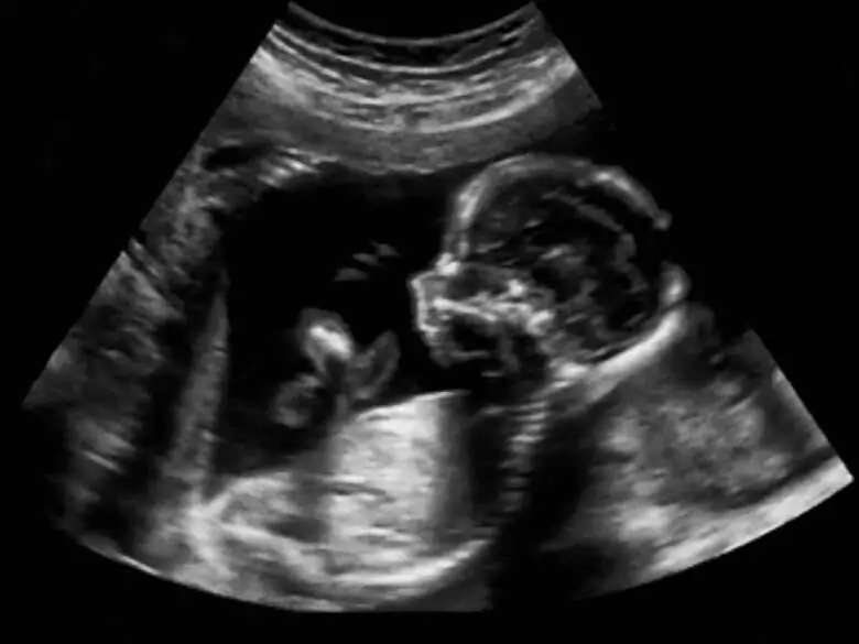Fetal growth disorders
