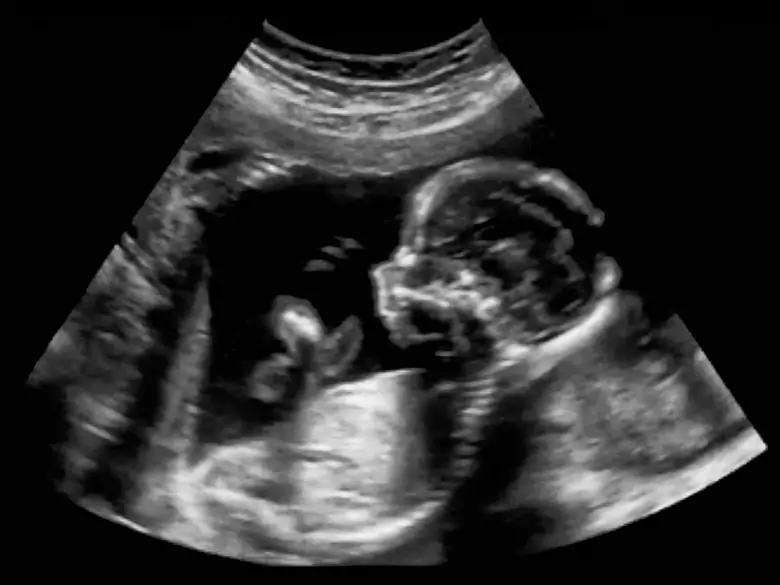 What is Jacobsen Syndrome?