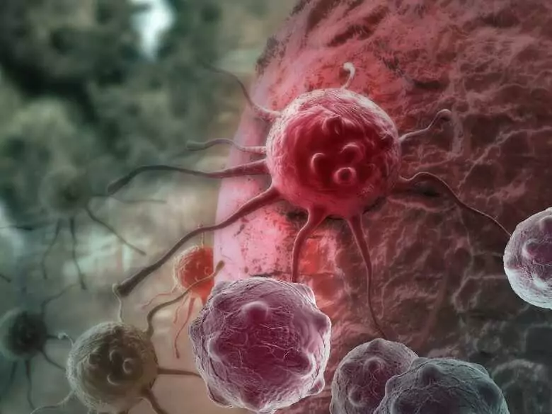 Aggressive pancreatic cancer and proteins that may promote its ability to metastasise