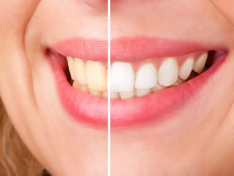 Whitening strips harmful to teeth?