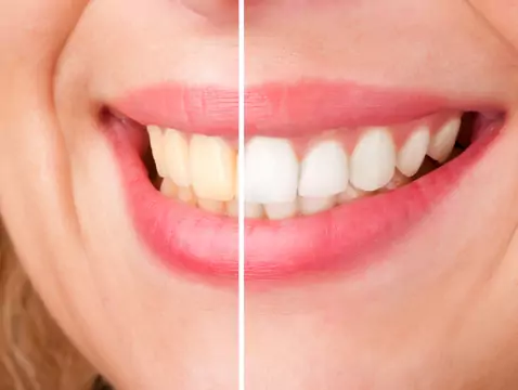 Teeth whitening - which method to choose?