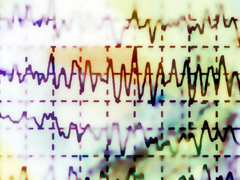 Canalopathies - genetically determined syndromes that cause cardiac arrhythmias