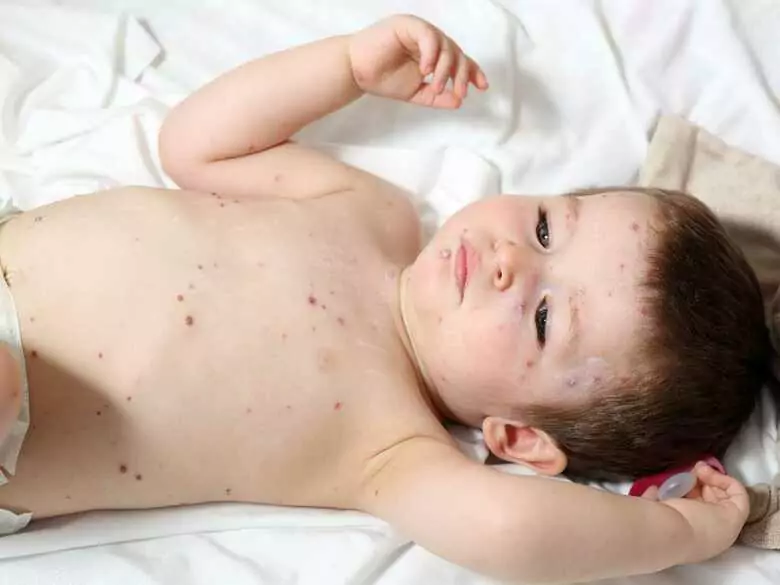 A child with a rash - when to see a doctor?
