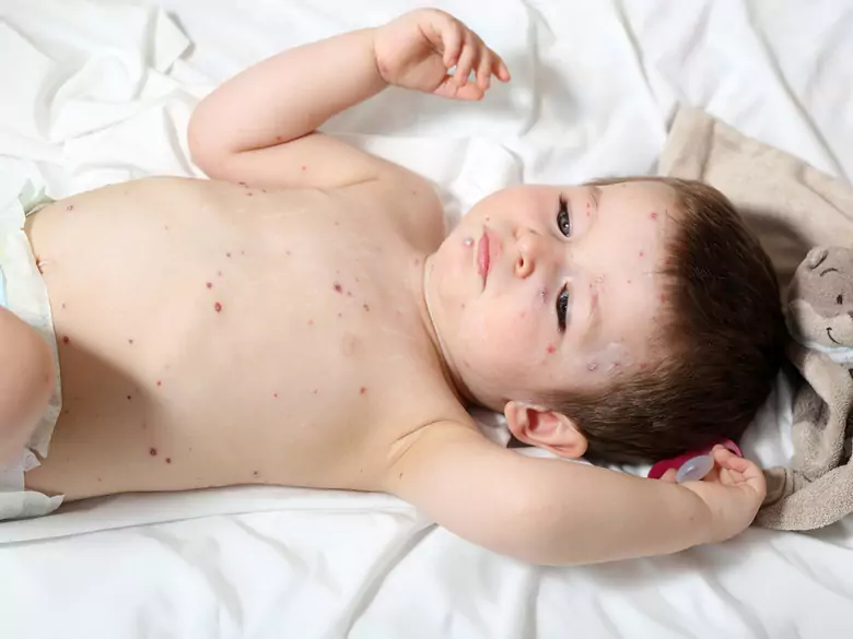 A child with a rash - when to see a doctor?