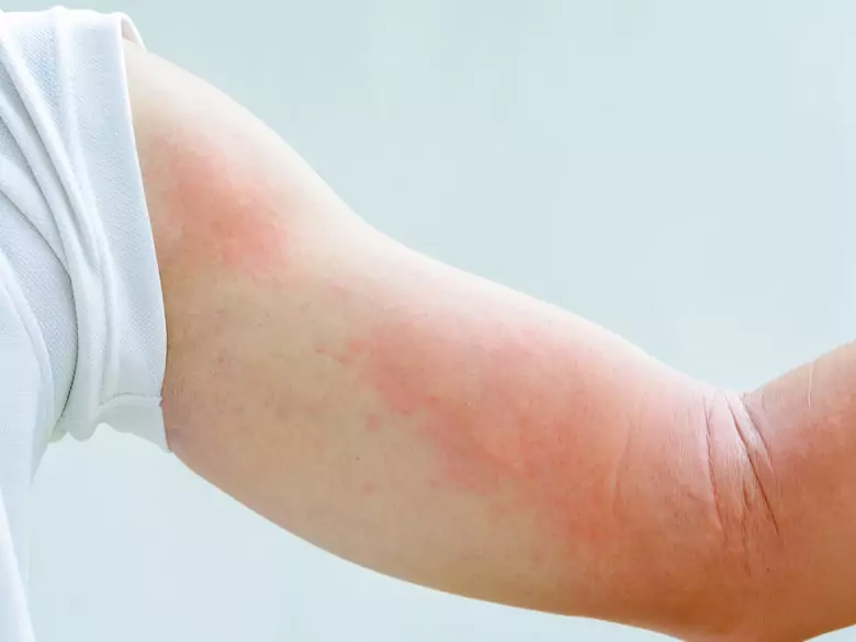 Recurrent shingles - clinical and immunological features