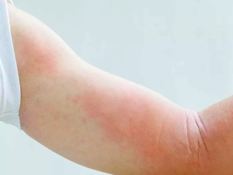 How to treat eczema?