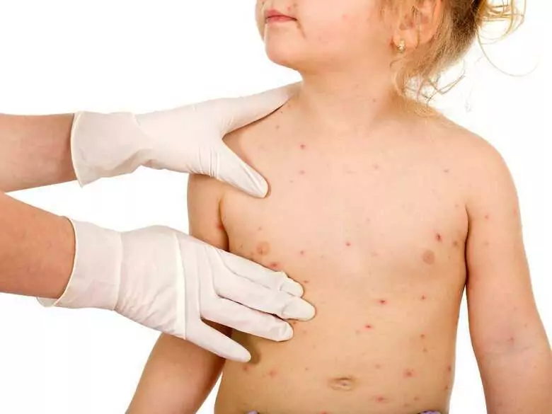 Home remedies to relieve chickenpox symptoms