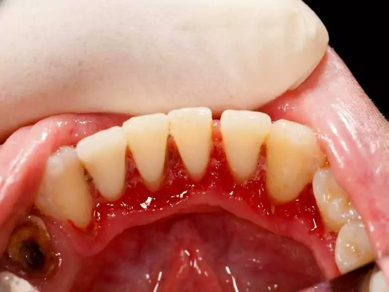 Gingivitis: can it be contracted?
