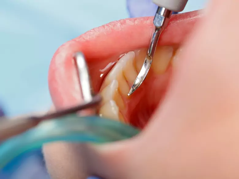 Gum abscess - treatment options