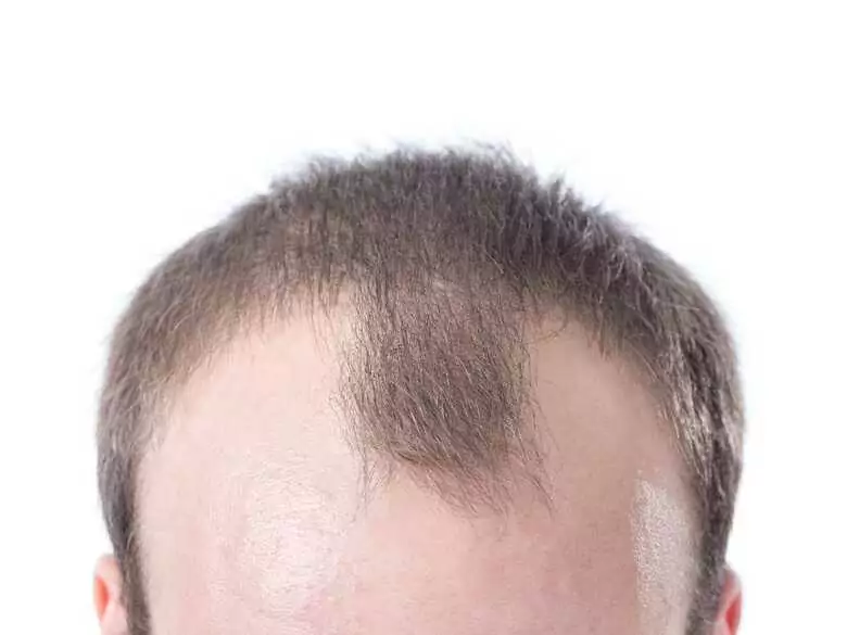 Can polluted air cause hair loss?