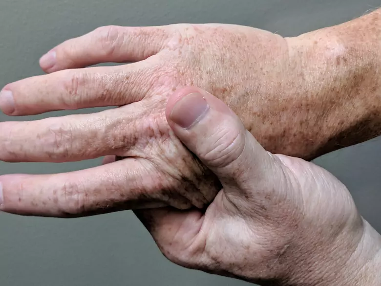 How to deal with arthritis problems?