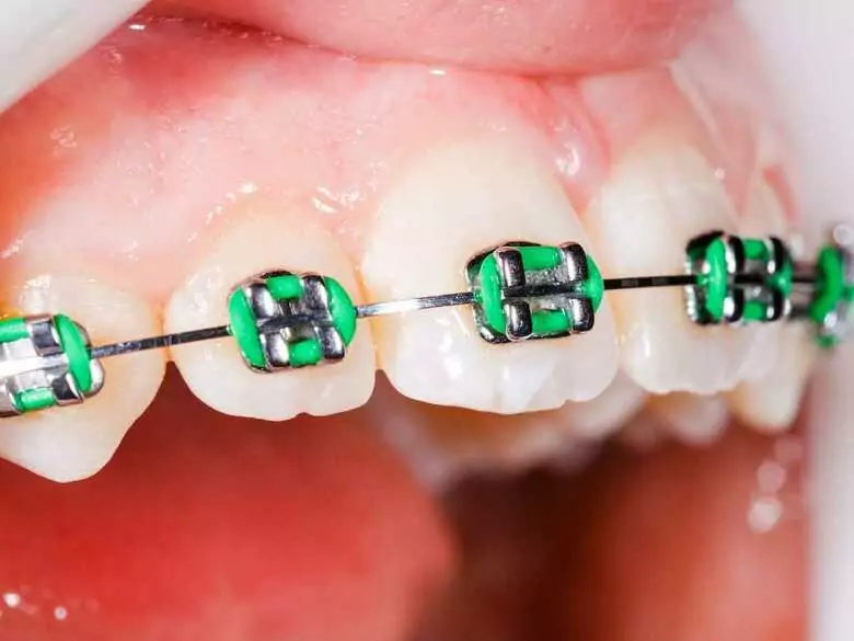 Is receding gums dangerous?