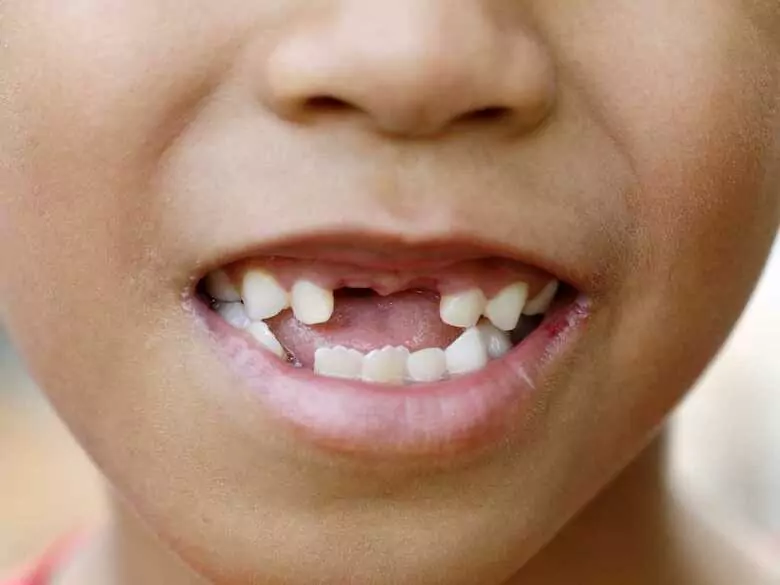 Baby teeth - do they need to be treated if they are going to fall out anyway?