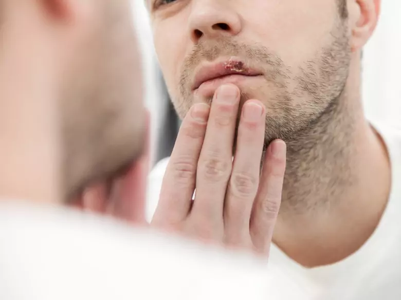 How to treat herpes?