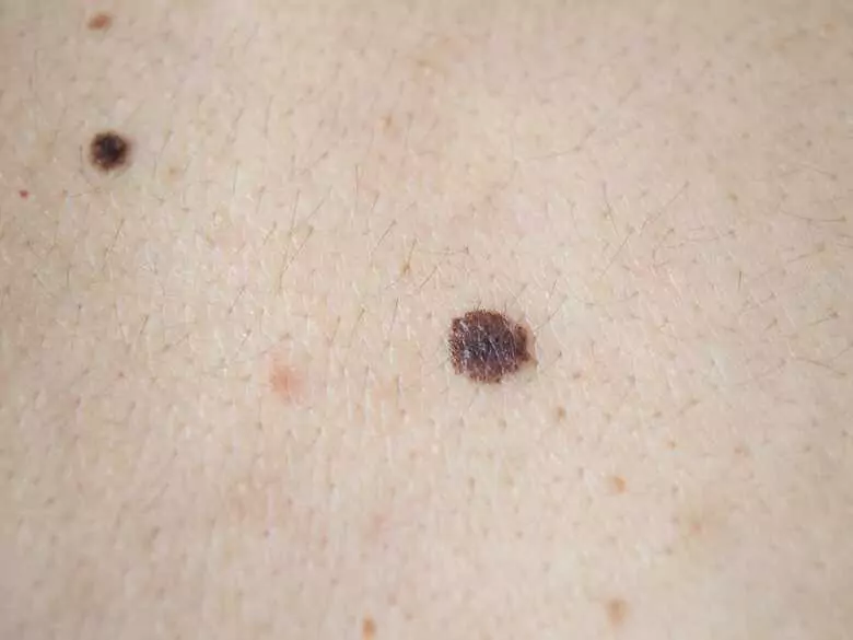 Skin self-examination: why should it be done and what should be of concern?