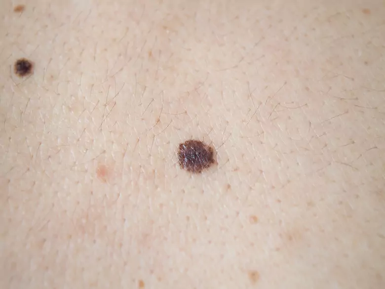Skin self-examination: why should it be done and what should be of concern?