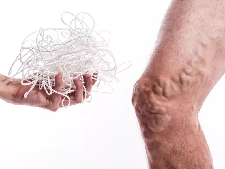 How to deal with venous insufficiency problems?